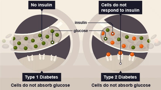 Type 1 Diabetes Stem Cell Therapy India